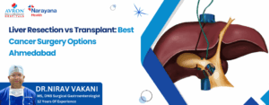 Liver Resection vs Transplant