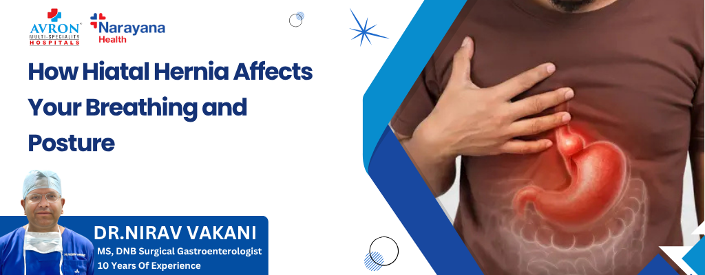 How Hiatal Hernia Affects Breathing and Posture