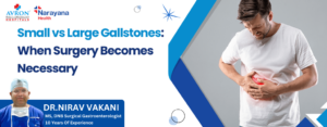 Small vs Large Gallstones